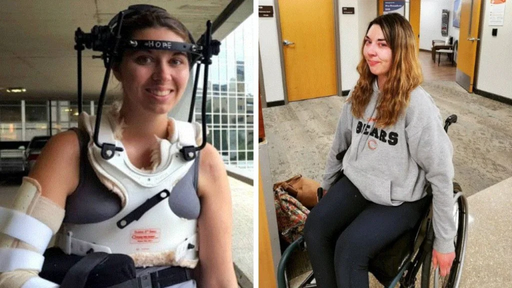 अमेरिकेतील फुटबॉलपटू महिलेची कवटी तब्बल ३७ शस्त्रक्रियांनंतर मानेला जोडली