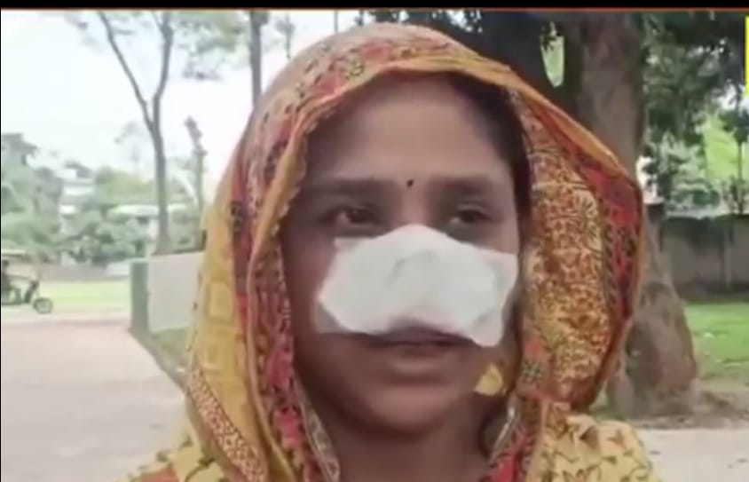 आवडले म्हणून बापन शेखने बायकोचे नाकच चावून गिळले