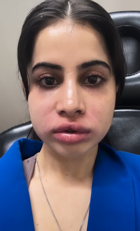 उर्फी जावेदच्या ओठांना आणि चेहऱ्याला काय झालंय?