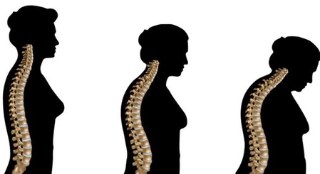 महिलांमध्ये कॅल्शियमची कमतरता ठरतीय समस्या