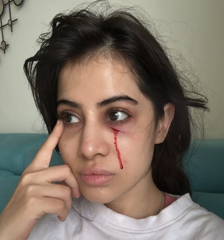 उर्फी जावेदला चेहऱ्यावर झाली जखम