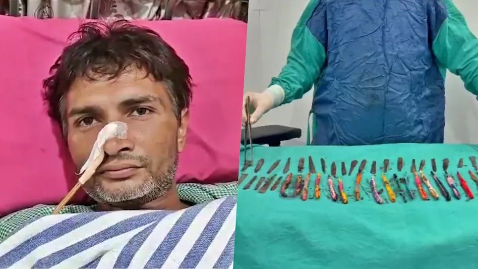 बाप रे! रुग्णाच्या पोटात २९ चमचे, १९ टूथब्रश अन दोन पेन!