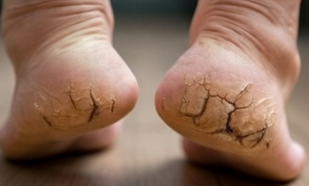 या आयुर्वेदिक उपायाने फुटलेल्या टाचांपासून मिळेल सुटका